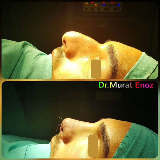 Rhinoplasty in Men Istanbul