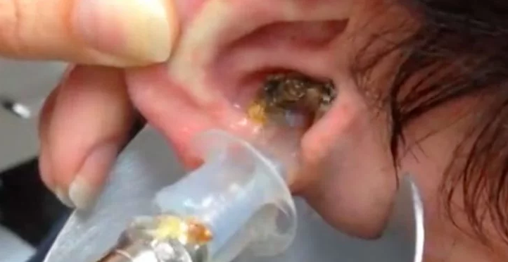 This Man Had Hearing Problems, You Will Never Guess What Came Out Of His Ear