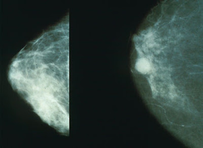 Mammogram.jpg