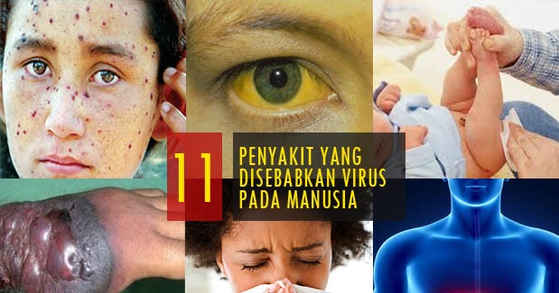 11 Penyakit yang Disebabkan oleh Virus pada Manusia dan 