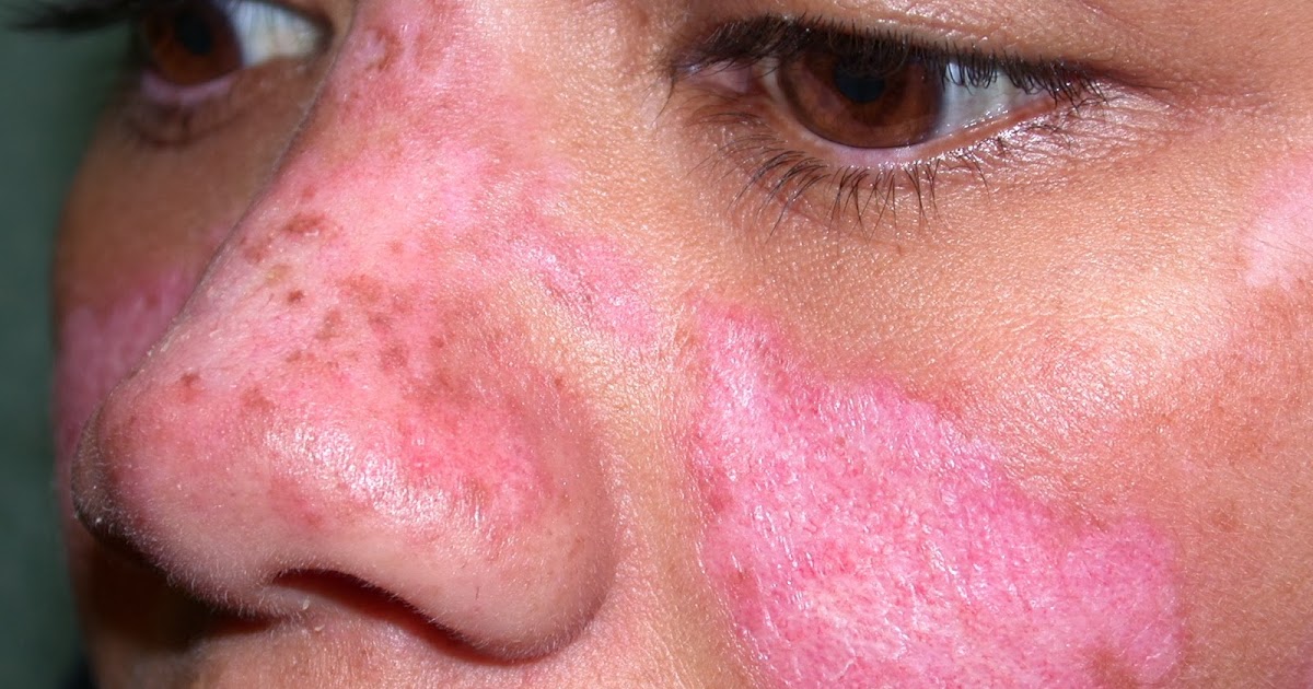 Artikel Mengenal Lupus Sipeniru Ulung