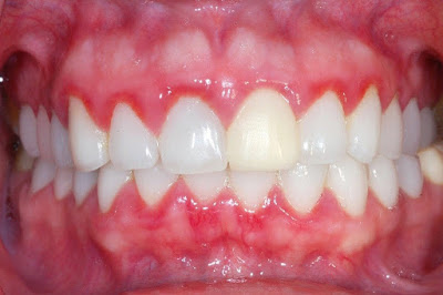 cách chữa sưng lợi