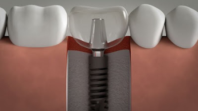 Implant nha khoa cho hàm răng chắc khỏe