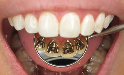 Lingual Braces Melbourne