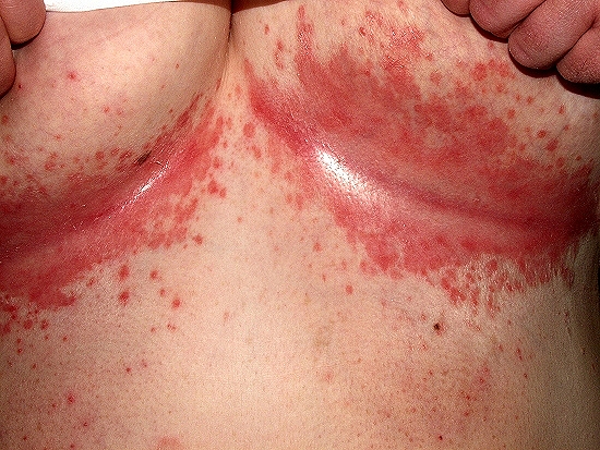 Derma-Docència Castelló: Intértrigo candidiásico vs. Psoriasis invertida