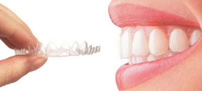 Niềng răng bằng nhựa dẻo có ưu điểm nào? 