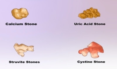 4 Kinds of kidney stones and symptoms, Uric acid stones, Calcium stones, Struvite stones, Cystine stones