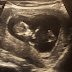 魁北克新手媽媽 產檢過程記錄 - 第一次超音波+抽血+驗尿  12W & 第二次抽血 15W