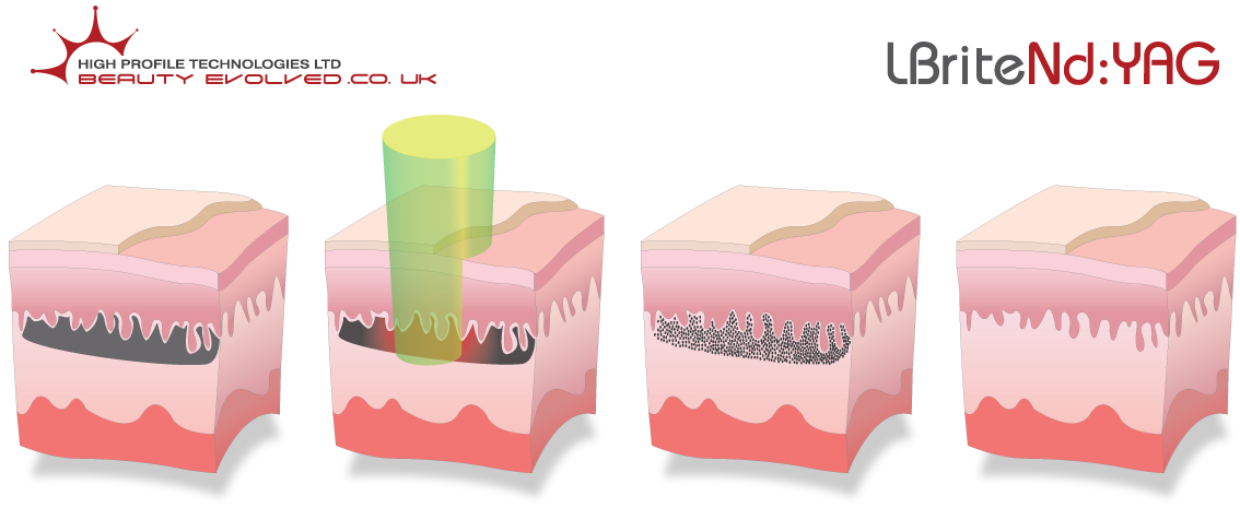 LBrite Nd:AYG Laser Tattoo Removal