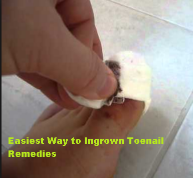 Easiest Way to Ingrown Toenail Remedies