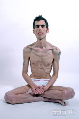 Jeremy Gillitzer, anorexic, bulimic, anorexia, bulimia