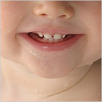 Chỉnh răng hô cho bé 12 tuổi bằng cách nào hiệu quả nhất?-1