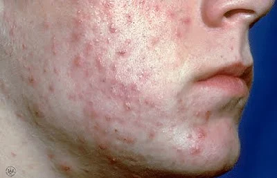 Acne And Pimple And Treatments