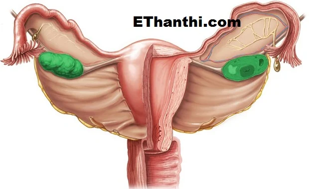 நீர் கட்டி அறிகுறிகள்