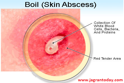 Home Remedies for Boils Baaltod