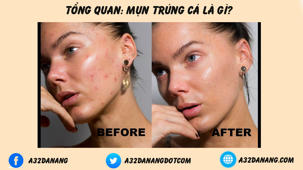 cách điều trị mụn trứng cá