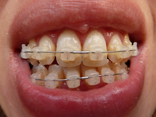 A photo of teeth with fixed ceramic braces at week 22 of treatment.