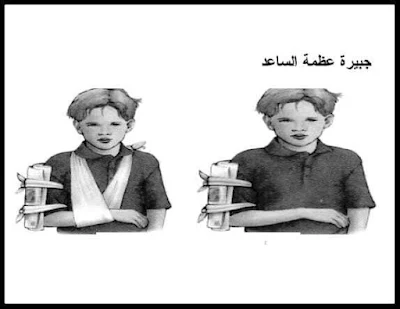 أنواع الجبيرة