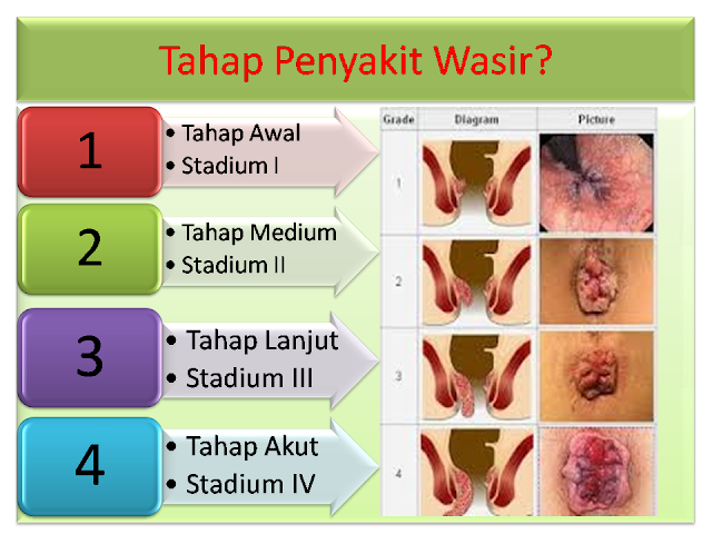 Tumbuhan Herbal Untuk Penyakit Ambeyen