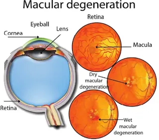 Age-Related Macular Degeneration (AMD)