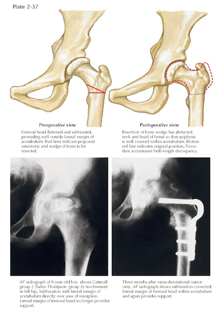 FEMORAL VARUS DEROTATIONAL OSTEOTOMY