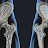 Ugonjwa wa osteoporosis,chanzo,dalili na Tiba