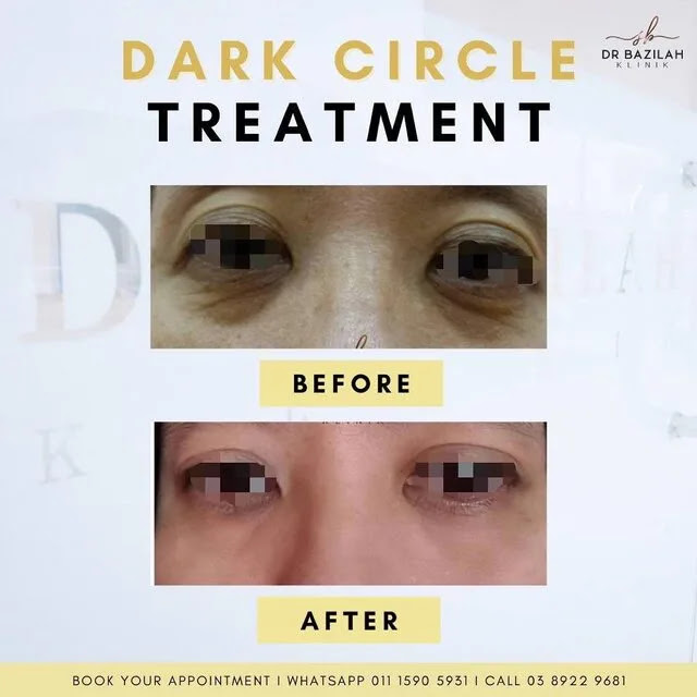 Cara Hilangkan Eyebag dan Dark Circle Dengan Cepat dan Berkesan di Klinik Dr. Bazilah