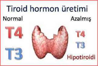 hipotiroidi sebepleri