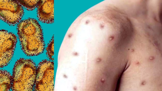 Monkeypox | Monkeypox Symptoms, Diagnosis and Treatments