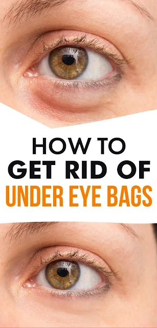 How To Get Rid Of Bags Under Eyes: 16 Home Remedies + Prevention Tips