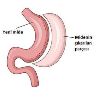 obezite cerrahi tüp mide