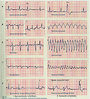 Jenis Macam Aritmia Disritmia Jantung