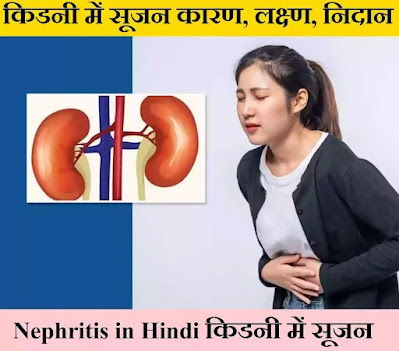 किडनी में सूजन - Nephritis in Hindi नेफ्राइटिस के कारण, लक्ष्ण और निदान