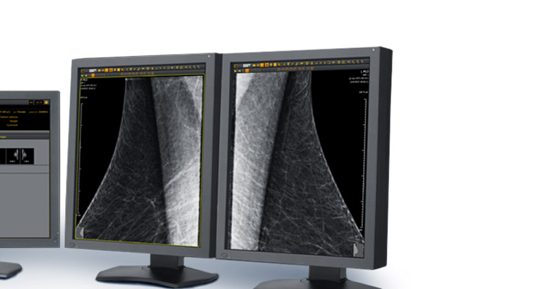 Mammography