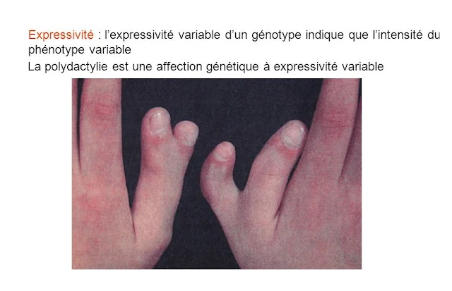 La polydactylie