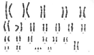 [geneticasindromedowncariotipo.jpg]