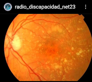 Situación de las enfermedades oculares crónicas
