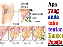 Kanser Prostat Pembunuh Senyap Lelaki Kedua Tertinggi Di Malaysia!