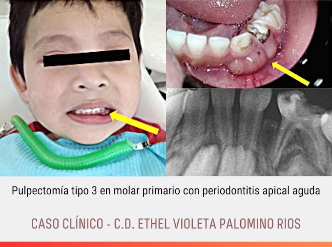 CASO CLÍNICO: Pulpectomía tipo 3 en molar primario con periodontitis apical aguda