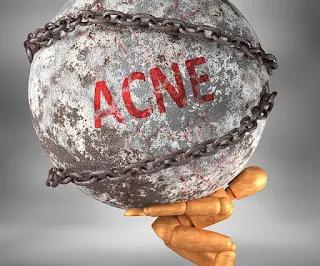 acne cure medicine