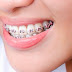 Quy trình niềng răng hô hàm trên