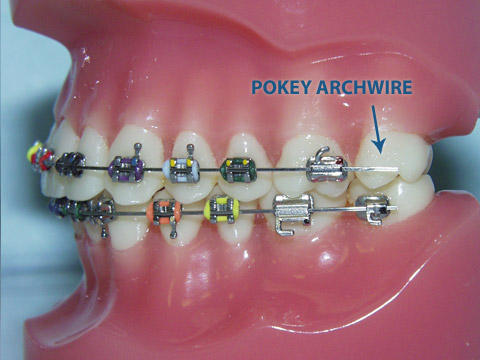 Bales Orthodontics: What should you do with a poking wire ...