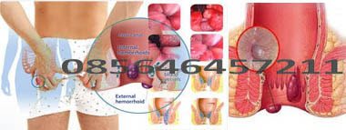 Obat Ambeien Menahun Dalam Bentuk Kapsul