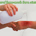 Home Remedies / Tips for Burns & Boilings