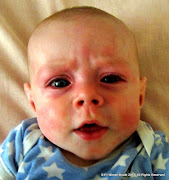 57/366Allergic Reaction?