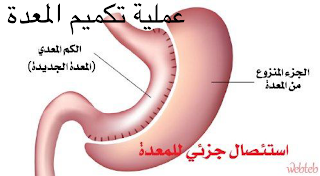 ما هي خطورة عملية تكميم المعدة | نصائح قبل اجراء عملية التكميم