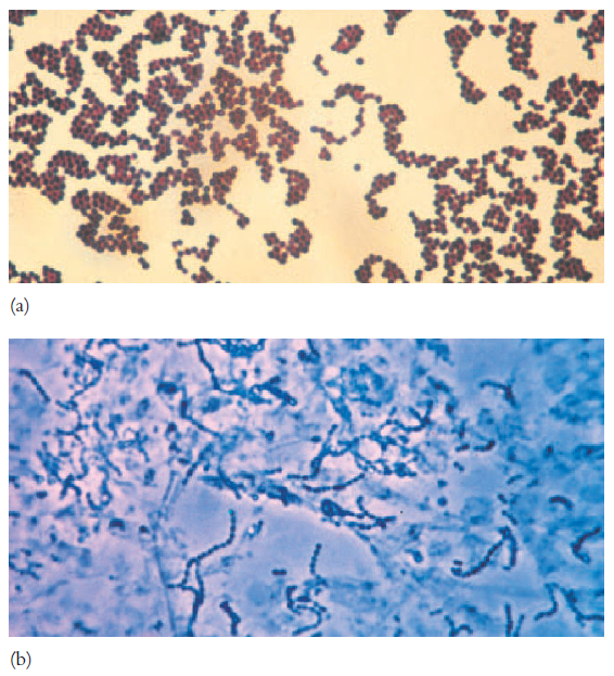 Staphylococcus aureus. Gram-positive spheres in irregular clusters and Enterococcus faecalis.