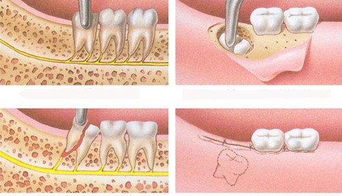 Nhổ răng số 8 bị sâu có ảnh hưởng gì ?