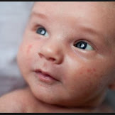 Baby Pimples: Treatment and Solution