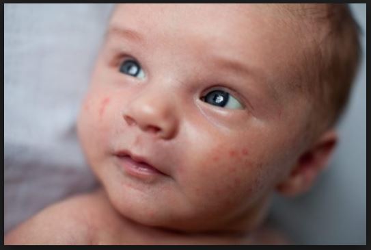 Baby Pimples: Treatment and Solution